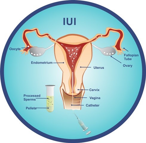 IUI Treatment in Mumbai, Navi Mumbai- Dr Ankita's Fertility Centre