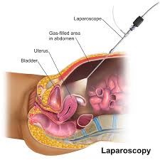 Laparoscopy Surgery